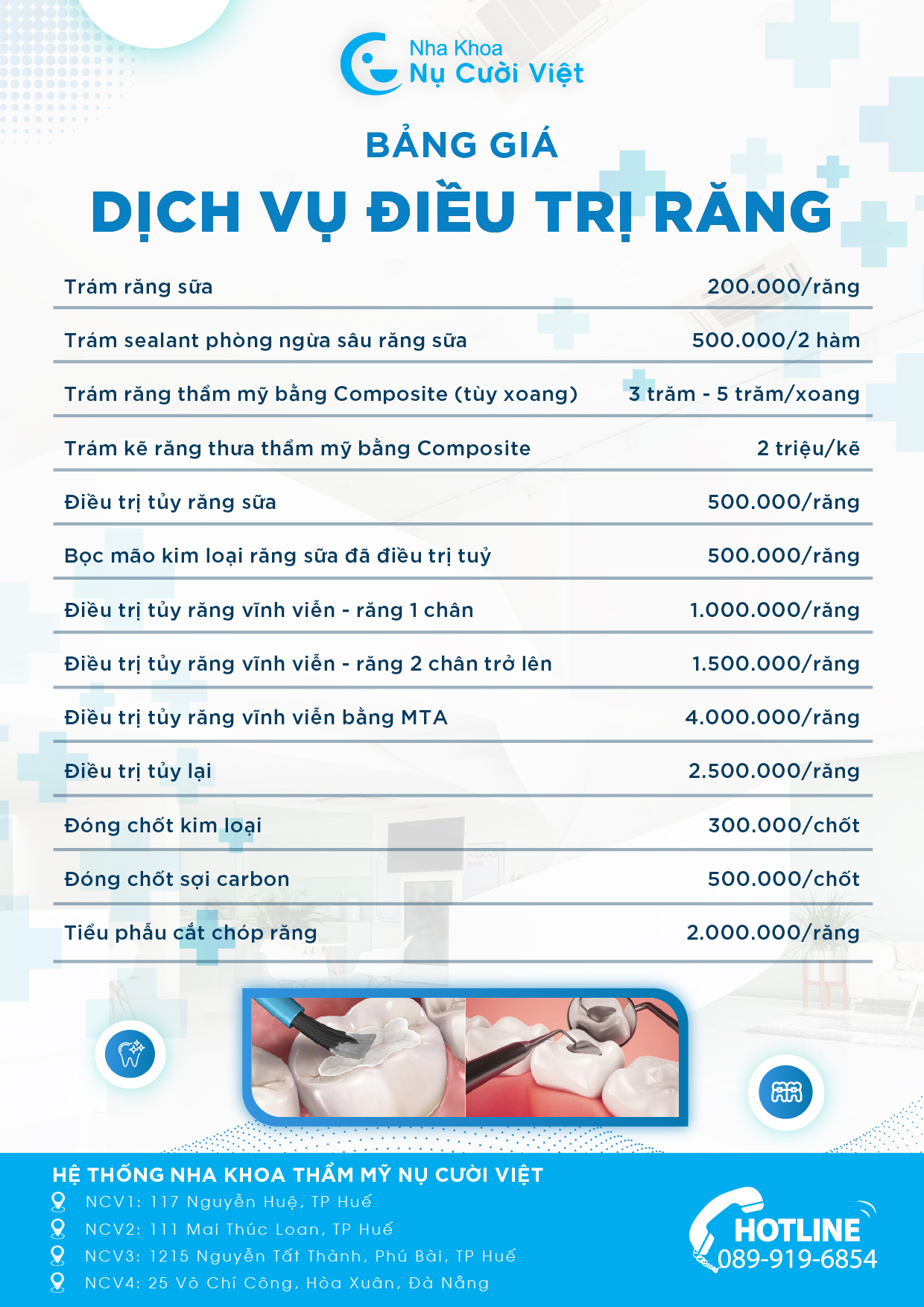 bảng giá trám răng