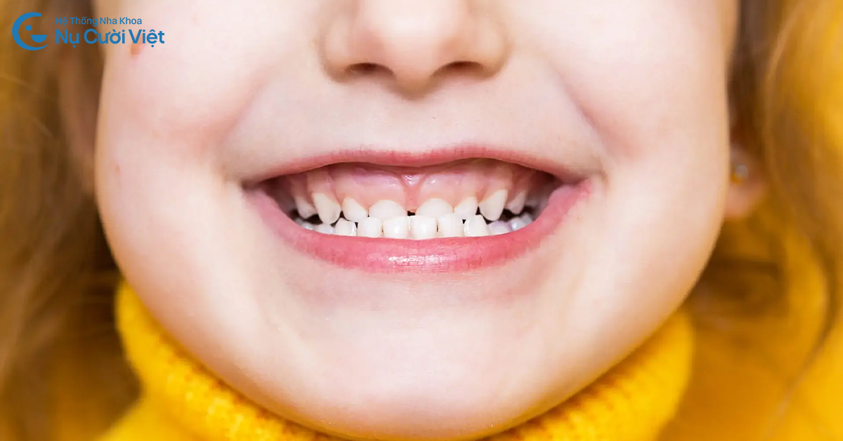 dấu hiệu trẻ bị móm khớp cắn ngược