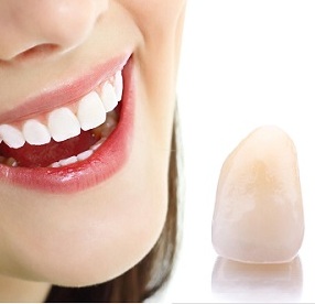 Nụ Cười Việt - BỌC RĂNG SỨ 