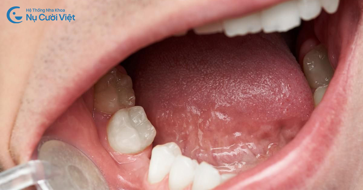 hậu quả mất răng