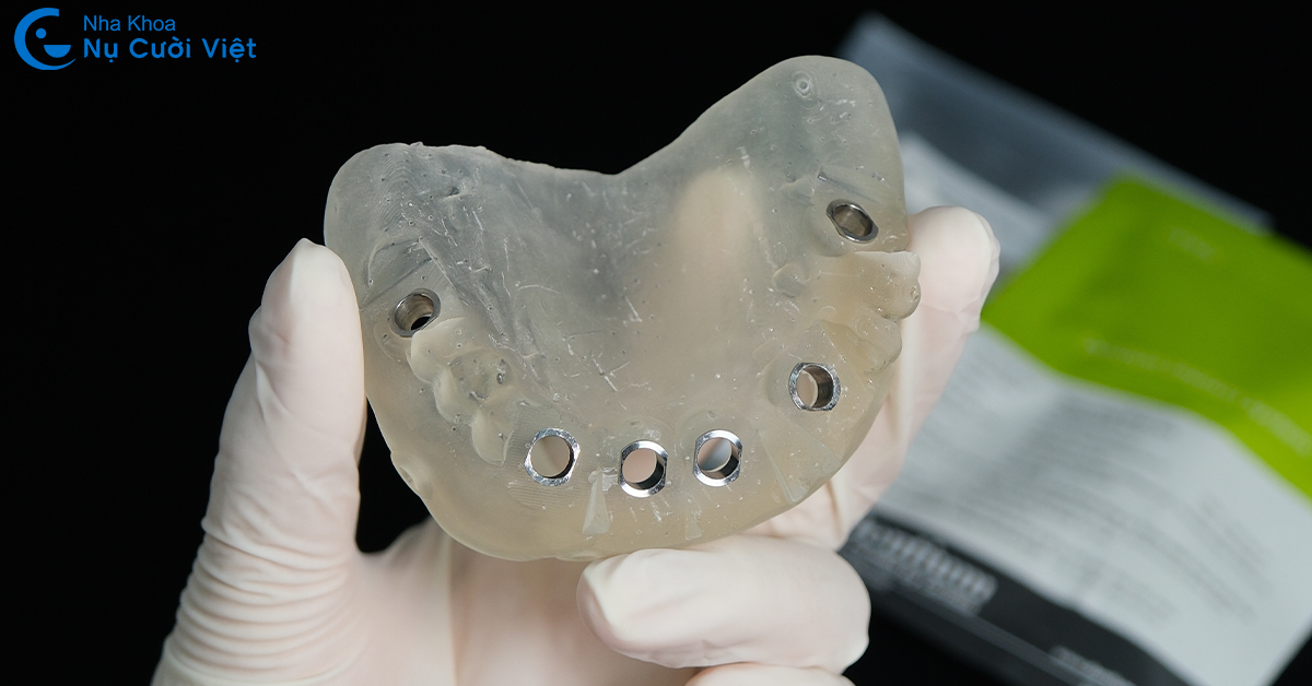 quy trình cấy ghép bằng máng hướng dẫn phẫu thuật implant tại nụ cười việt