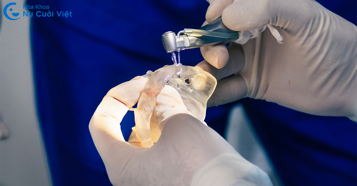 máng hướng dẫn phẩu thuật implant tại nha khoa nụ cười việt