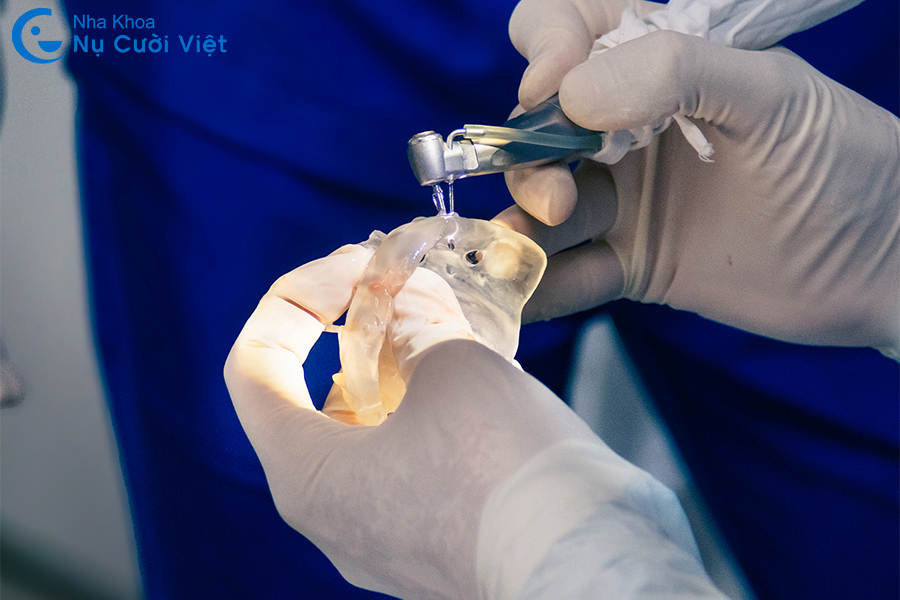 Nụ Cười Việt - Trồng răng với máng hướng dẫn phẫu thuật Implant - An toàn, chính xác, hồi phục nhanh