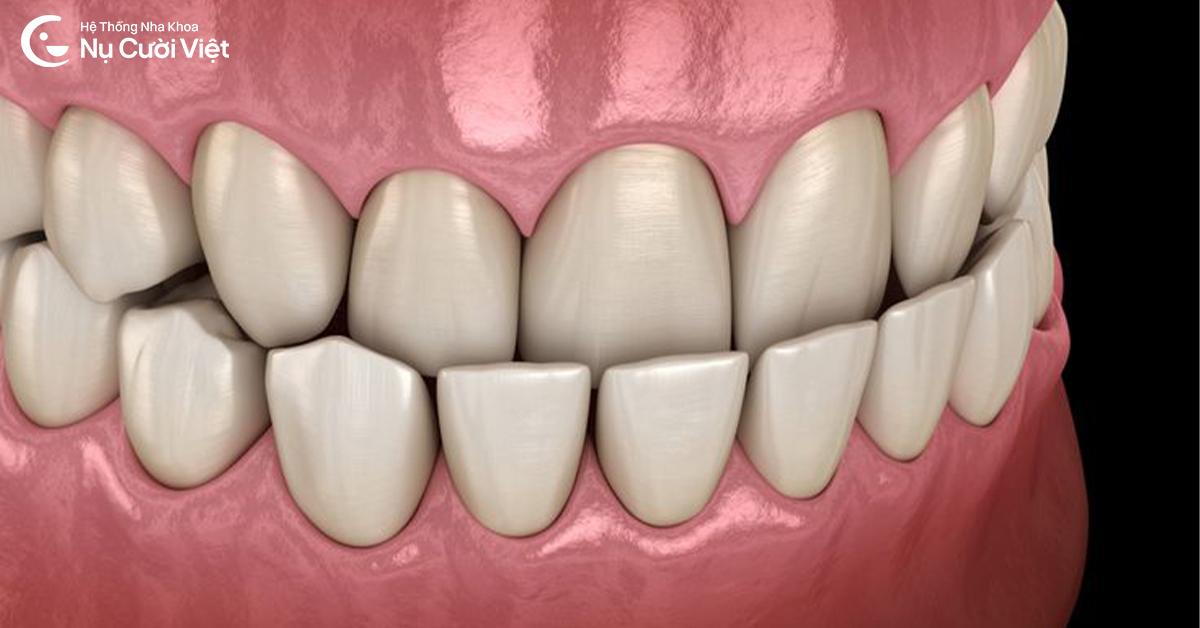 nguyên nhân bị móm