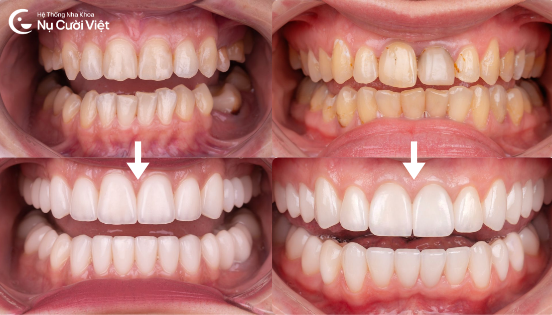 dán sứ răng khấp khểnh